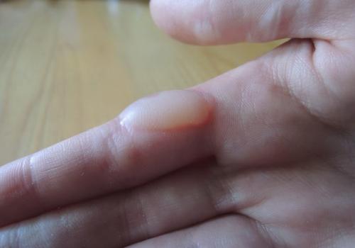 Мазь от влажных мозолей. Мокрая или водяная мозоль.