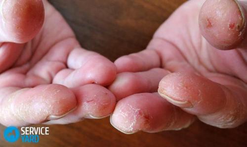 Шелушится кожа на подушечках пальцев рук причины у женщин. По каким причинам облазит кожа на руках?
