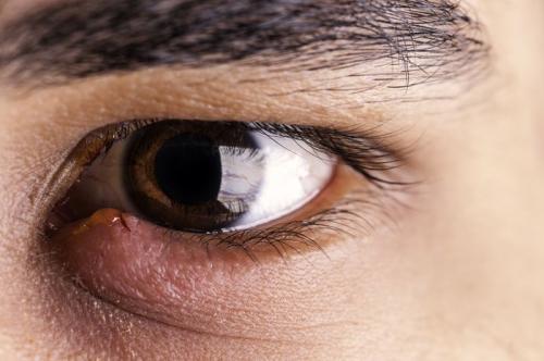 Покраснение под глазом и отек. Полезное видео