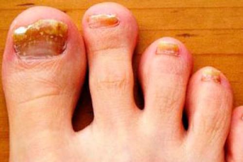 Как лечить запущенный грибок ногтей на ногах. Как вылечить запущенный грибок ногтей на ногах?