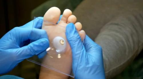 Сухой мозоль на пальце ноги со стержнем. Стержневая мозоль