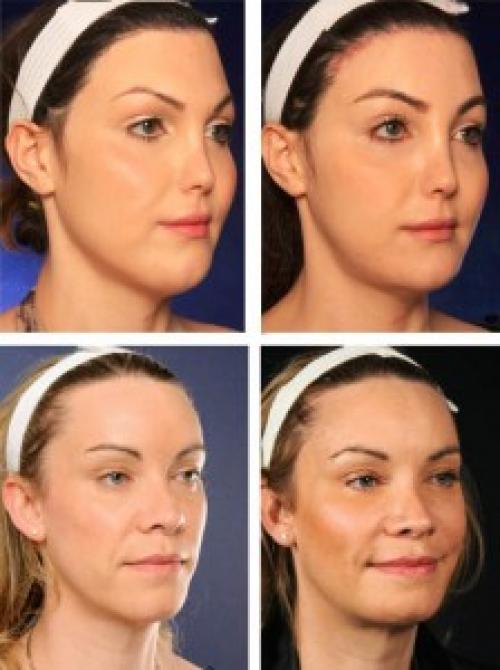 Упражнения для увеличения щек. Как сделать щеки пухлыми: упражнения – народные рецепты — видео