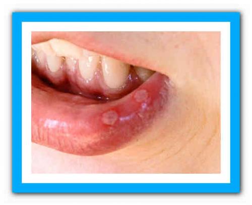 Черные точки на губах. Что делать с чёрной точкой на губе? 03 Черные точки на губах. Что делать с чёрной точкой на губе? 03