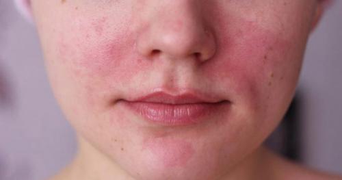 Недорогие аптечные средства от купероза. Как ухаживать за кожей, чтобы устранить сосудистые звездочки?