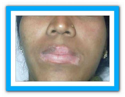 Черные точки на губах. Что делать с чёрной точкой на губе? 04 Черные точки на губах. Что делать с чёрной точкой на губе? 04