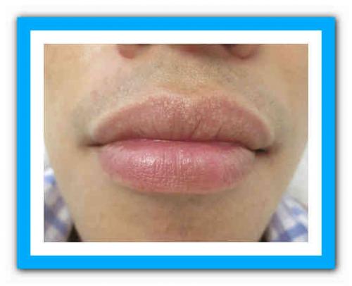 Черные точки на губах. Что делать с чёрной точкой на губе? 05 Черные точки на губах. Что делать с чёрной точкой на губе? 05