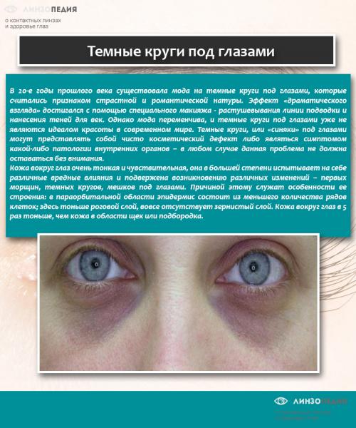 Как убрать темные круги вокруг глаз в домашних условиях быстро. Как от них избавиться?