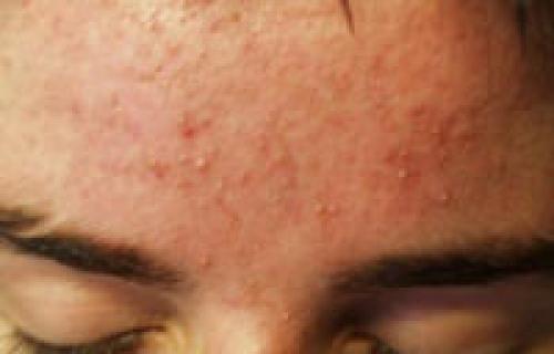 Как убрать на лице черные точки в домашних условиях. Как быстро убрать черные точки на лице в домашних условиях активированным углем 03