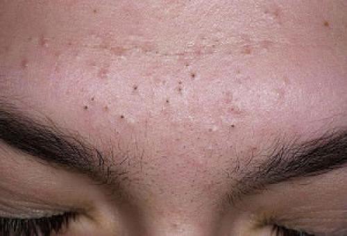 Пластырь от черных точек в домашних условиях. Обзор пластырей от черных точек