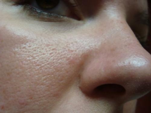 Пористая жирная кожа лица лечение. Как избавиться от пористой кожи на лице?