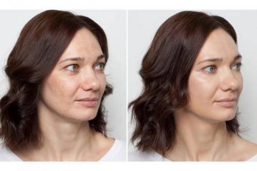 Какого цвета корректор для пигментных пятен. Как скрыть пигментацию и выровнять тон лица с помощью цветных корректоров?