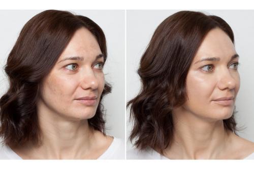 Чем замазать пигментные пятна на лице. Арсенал косметических продуктов 03 Чем замазать пигментные пятна на лице. Арсенал косметических продуктов 03