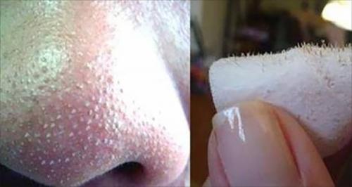 Как очистить лицо от черных точек и прыщей в домашних условиях. Чистка лица в домашних условиях от прыщей и черных точек