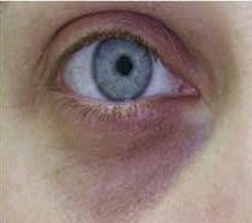 Синяки под глазами лечение. Синяки под глазами, как следствие образа жизни