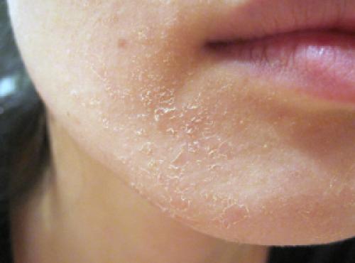 Как избавиться от шелушения на лице за один день. Главные причины сильного шелушения