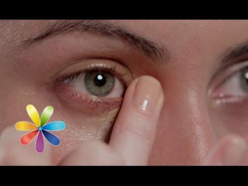 Желтые круги вокруг глаз у мужчин. Желтые круги под глазами у женщин и мужчин: причины, лечение