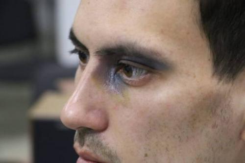 Как убрать черные круги под глазами в домашних условиях. Аллергические реакции 06 Как убрать черные круги под глазами в домашних условиях. Аллергические реакции 06