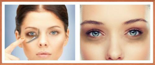 Темные круги под глазами причины. Причины появления черных кругов под глазами у человека