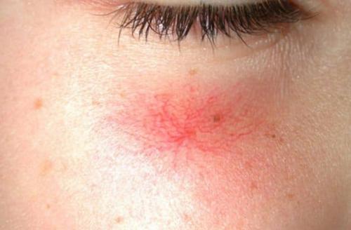 Как бороться с жирной кожей. К каким последствиям приводит