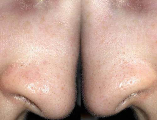 На носу большие поры. Почему нельзя сужать поры на носу