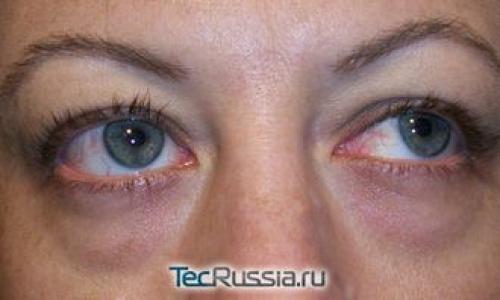 Темные круги под глазами печень. Круги под глазами у ребенка — вероятные обстоятельства их появления