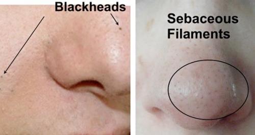 На носу большие поры. Почему нельзя сужать поры на носу