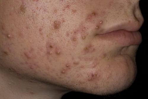 Как бороться с жирной кожей. К каким последствиям приводит