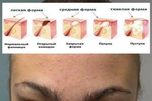 Как бороться с жирной кожей. К каким последствиям приводит