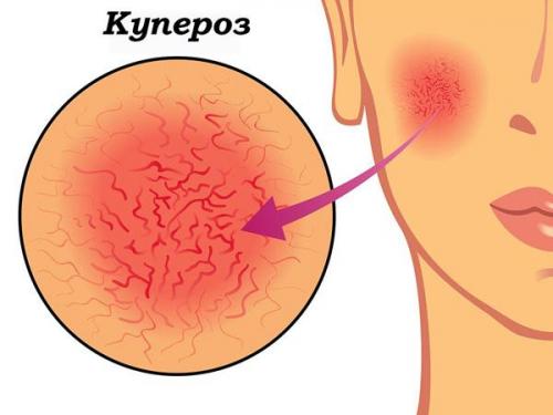 Ана кислоты, что это. Что нужно знать о косметике с кислотами AHA и BHA 20 Ана кислоты, что это. Что нужно знать о косметике с кислотами AHA и BHA 20