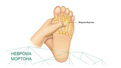 Острая боль в стопе без причины. Боли в стопе: причины и лечение