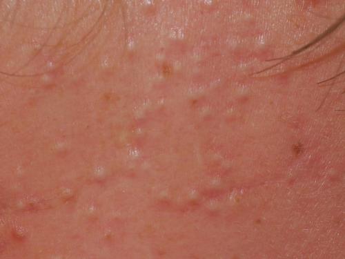 Как я избавилась от закрытых комедонов. Устраняем причину: почему появляются закрытые комедоны?