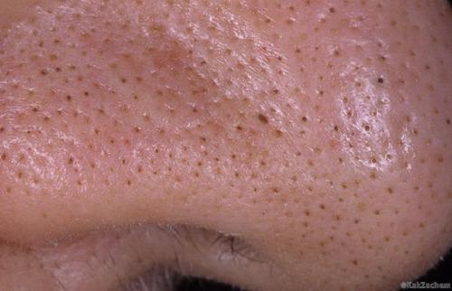 Какая чистка лица лучше от черных точек. Чистка лица в домашних условиях от черных точек