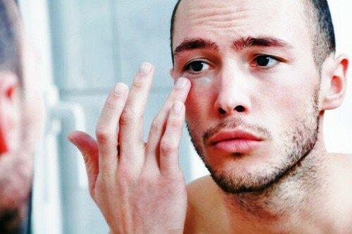 Синяки под глазами у мужчин. Круги, синяки и чернота под глазами у мужчин: причины