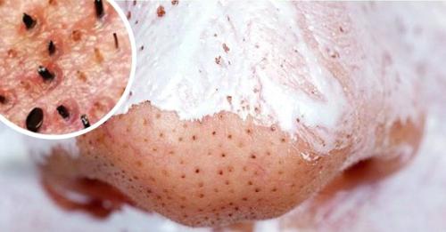 Какая чистка лица лучше от черных точек. Чистка лица в домашних условиях от черных точек