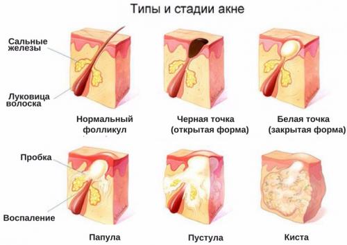 Как сузить поры на лице в салоне. Почему расширяются