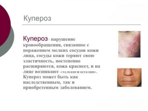 Маски при куперозе на лице с аскорутином. Что такое маска от купероза