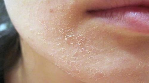 Почему шелушится кожа на лице. Причины и симптомы