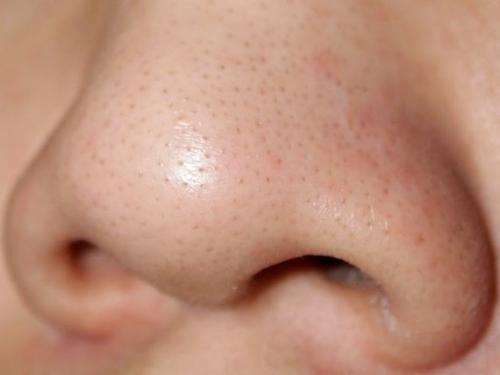 Большие поры на носу. Почему нельзя сужать поры на носу