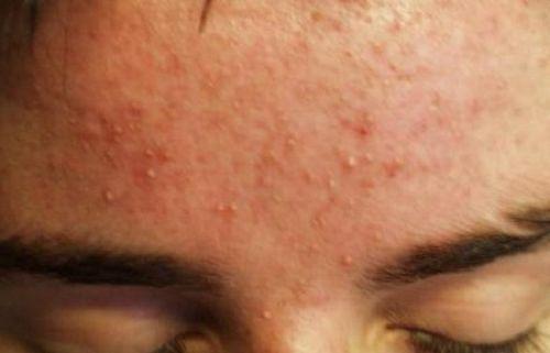 Прыщи и жирная кожа на лбу. Причины появления прыщей на лбу у женщин 01