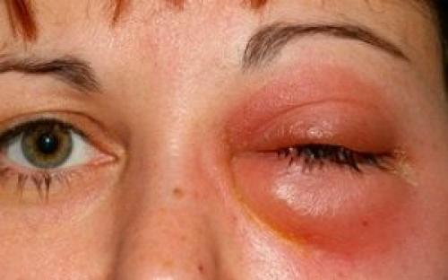 Красные круги под глазами почему. Причины возникновения симптома у взрослых 06