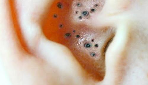 Удаление черных точек в ухе. Чёрные точки в ушах, как избавиться, видео