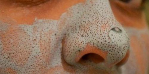 Черные точки на носу, что это. Почему появляются черные точки на носу?