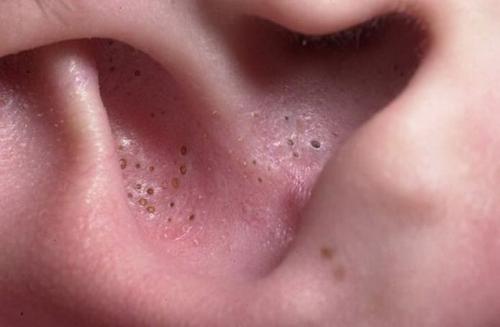 Удаление черных точек в ухе. Чёрные точки в ушах, как избавиться, видео