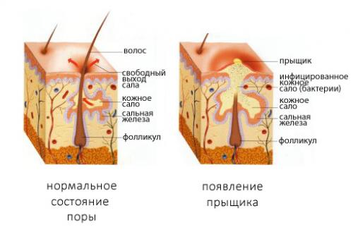 Как избавиться от прыщей. Общие сведения