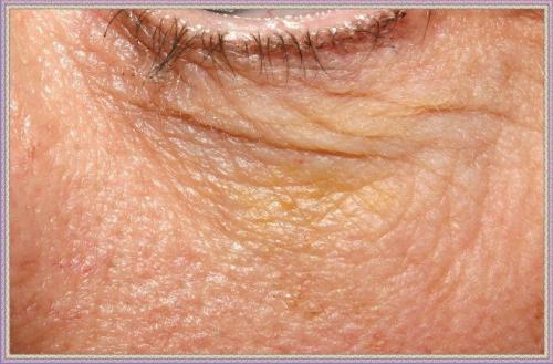 Желтые мешки под глазами у мужчин. Предупреждаем желтые пятна под глазами у женщин и мужчин