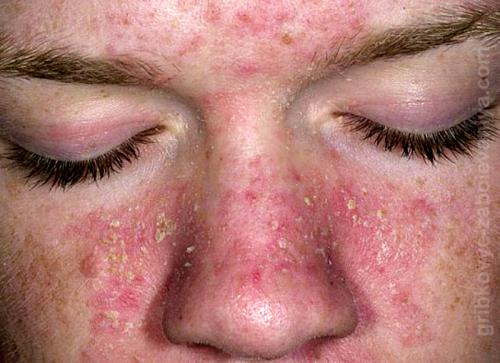 Кожа стала сухой и шелушится. Народные средства для сухой кожи лица 04 Кожа стала сухой и шелушится. Народные средства для сухой кожи лица 04