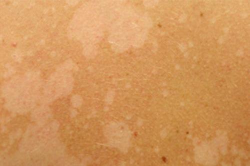 Кожа стала сухой и шелушится. Народные средства для сухой кожи лица 03 Кожа стала сухой и шелушится. Народные средства для сухой кожи лица 03