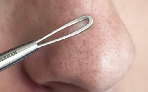 Средство народное от черных точек. Маски от черных точек на лице 01 Средство народное от черных точек. Маски от черных точек на лице 01