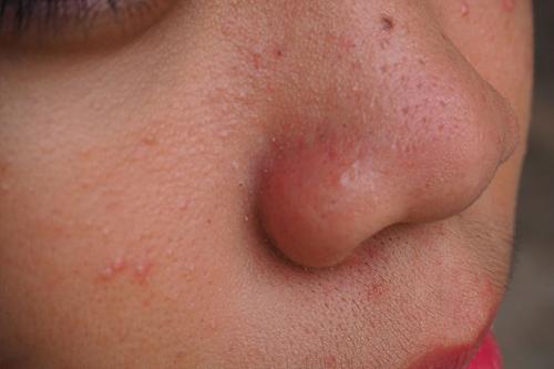 Маска от черных точек на носу. 16 рецептов масок для удаления черных точек на носу