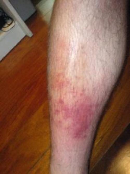 Тонкая кожа на ногах. Как лечится сухая кожа на голени ног